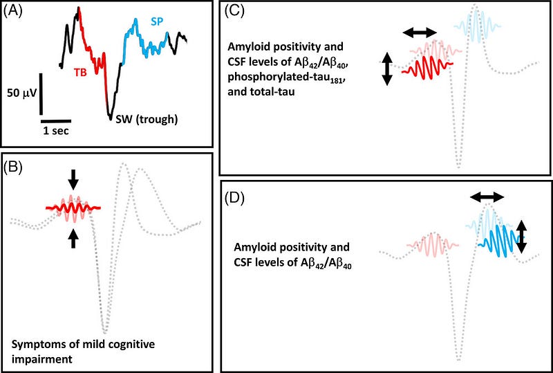 Illustrative representation of cognitive impairment on EEG