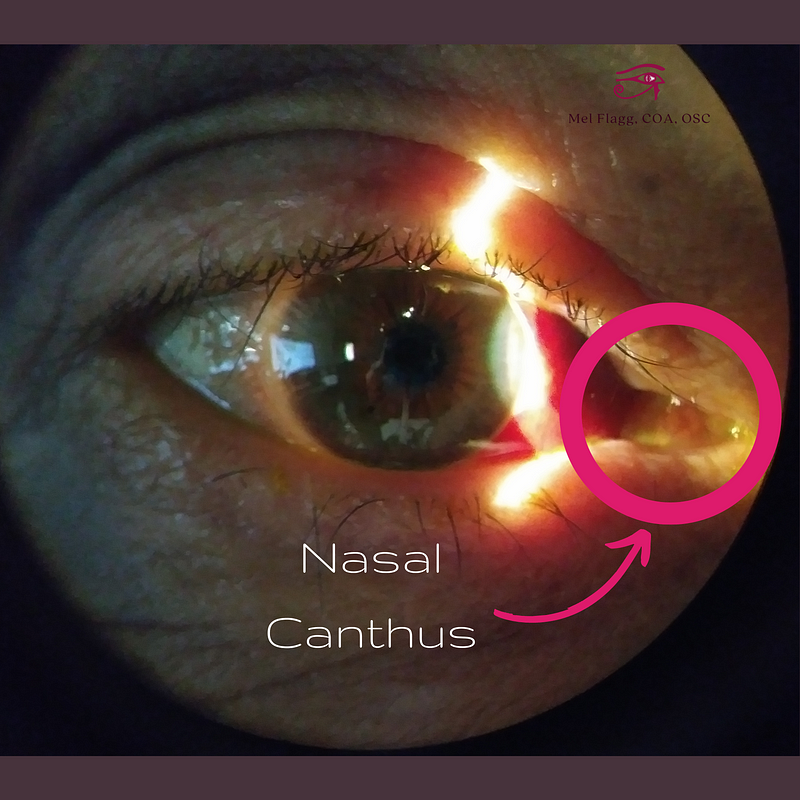 Image of the nasal canthus and subconjunctival hemorrhage