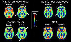 Brain activity during menopause