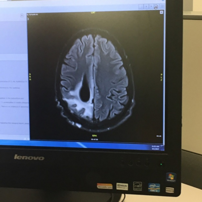 An MRI scan showing Adam's surgical cavity.